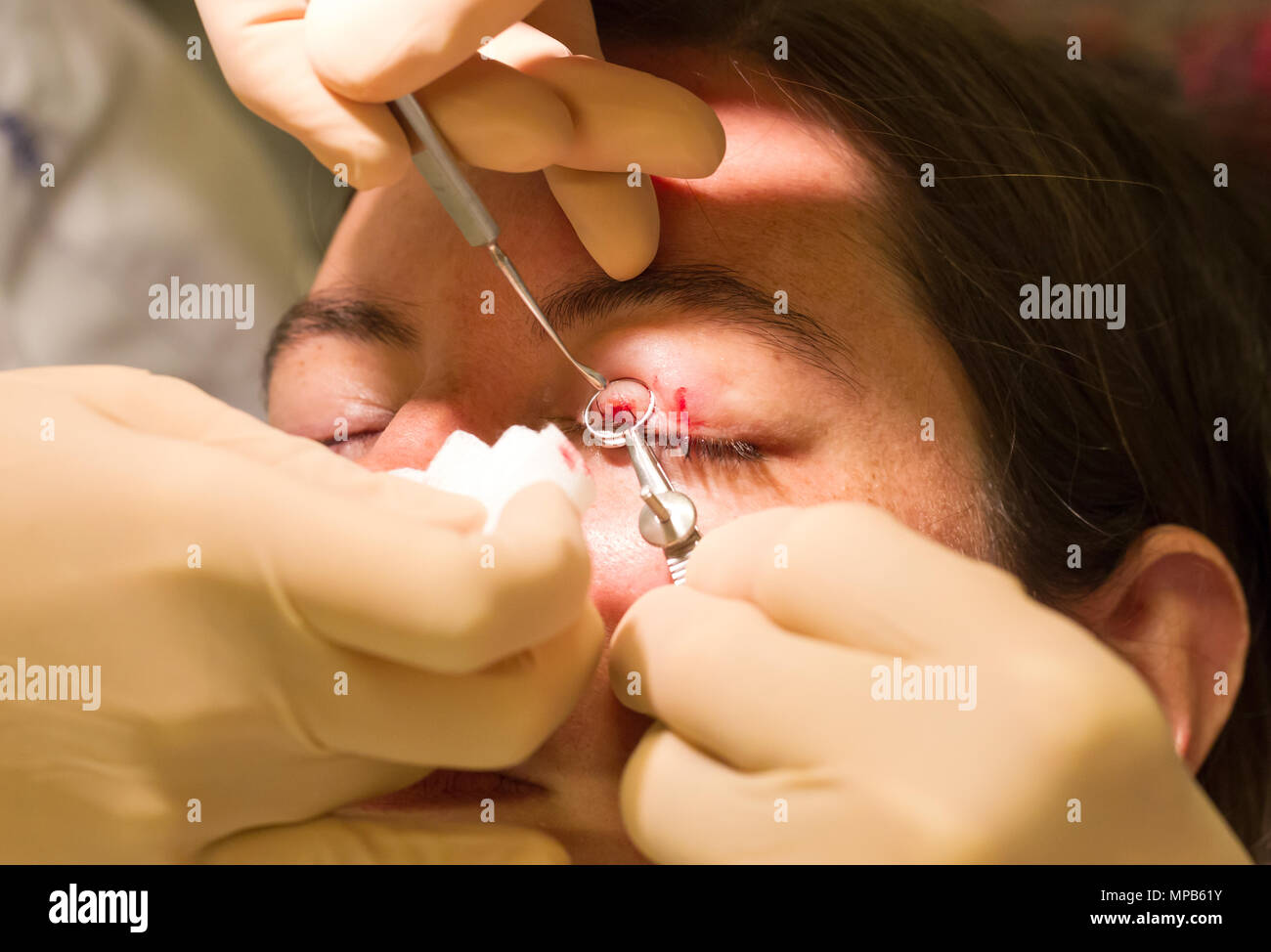 Healthcare Konzept - Chalazion während Auge Prüfung und Betrieb - Weiblich Stockfoto