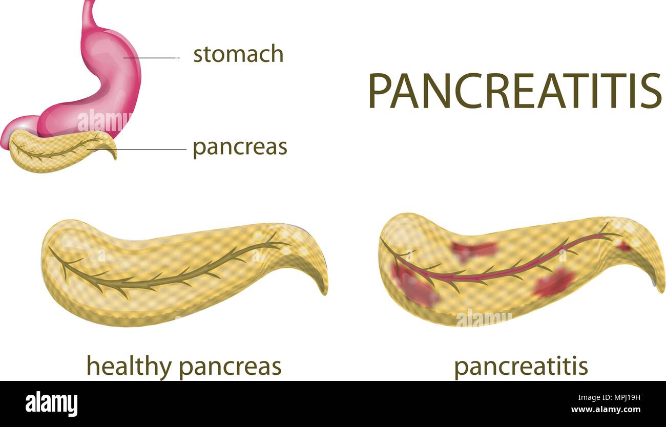 Болезни желудка и поджелудочной. Поджелудочная железа при хроническом панкреатите. Острый панкреатит поджелудочной железы. Острый и хронический панкреатит. Остром и хроническом панкреатите.