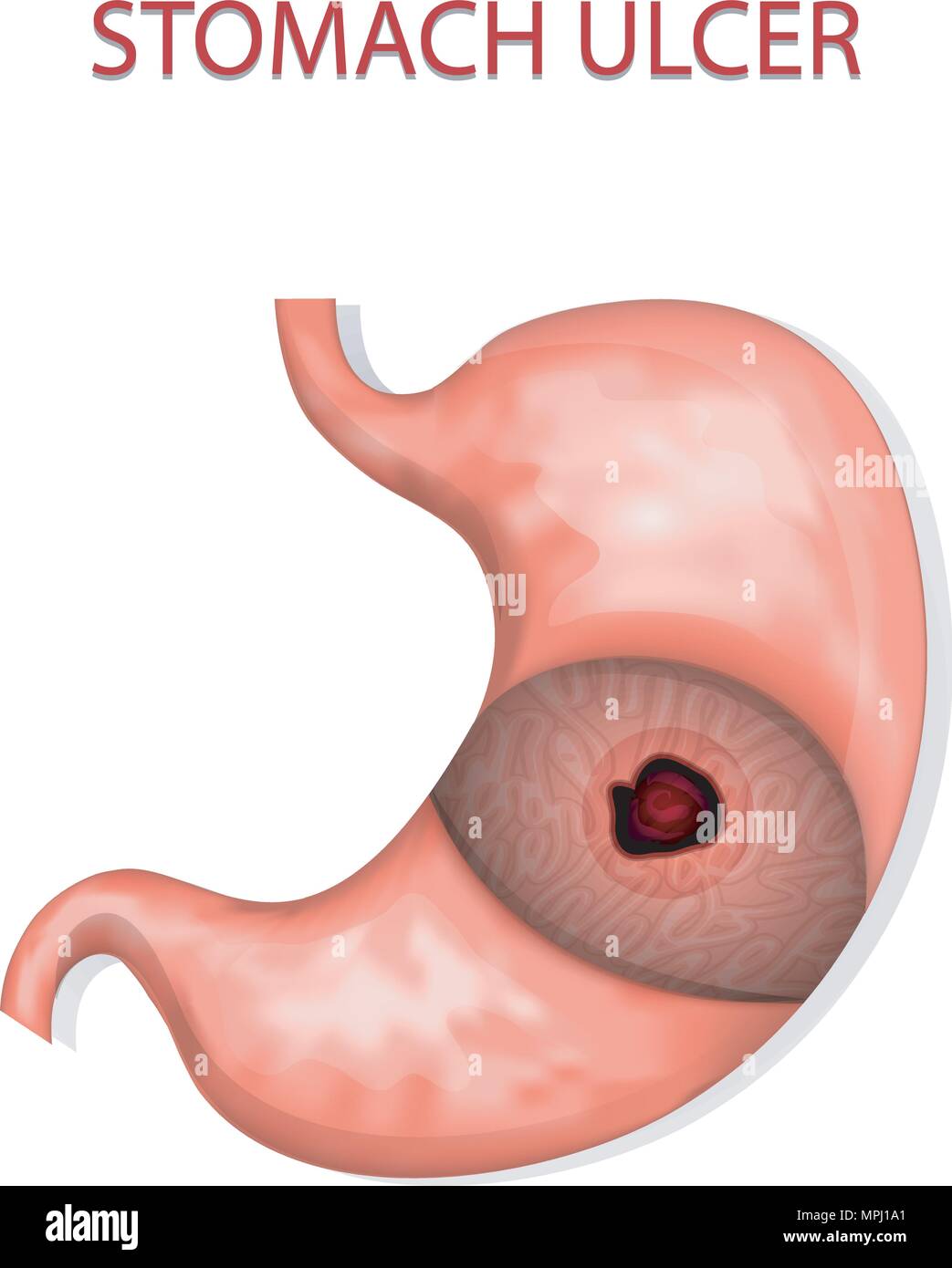 Darstellung der Magengeschwüre. Gastroenterologie. Gaster Stock Vektor