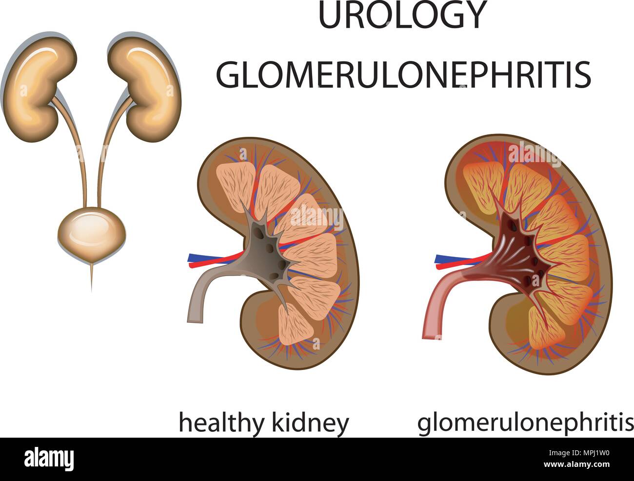 Urologie, Gesunde Nieren- und Glomerulonephritis. Vergleich. Vektor Stock Vektor