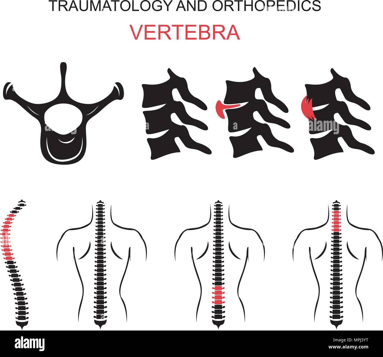Abbildung der Wirbelsäule, Wirbel, Wirbelsäule Bandscheibenvorfall, Verstauchungen, Skoliose. Schematische Darstellung von Rückenschmerzen und Rückenprobleme. Für alle sp erstellt Stock Vektor