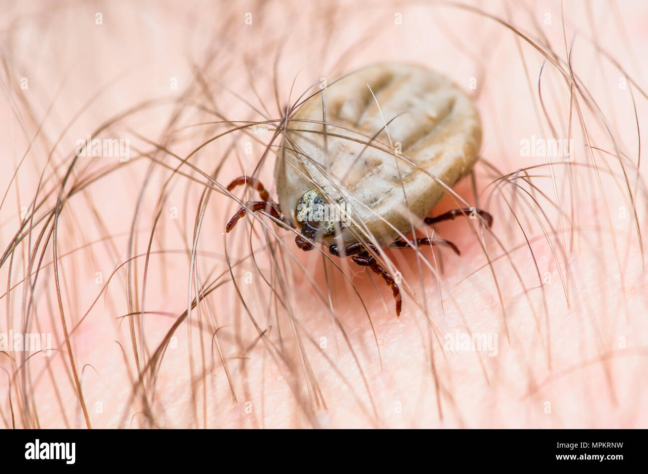 Enzephalitis Virus oder Lyme Krankheit oder Affe Fieber infizierte Zecke Spinne Insekt auf der Haut Stockfoto