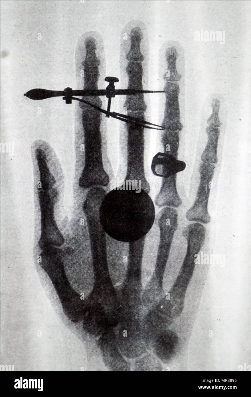 Frühe Röntgen X-Ray von Hand Wilhelm Röntgen Frau. Wilhelm Röntgen (1845-1923) ein deutscher Maschinenbauer und Physiker, die produziert und erfasst elektromagnetische Strahlung im Wellenlängenbereich als X-Strahlen von Röntgen Strahlen bekannt. Vom 19. Jahrhundert Stockfoto