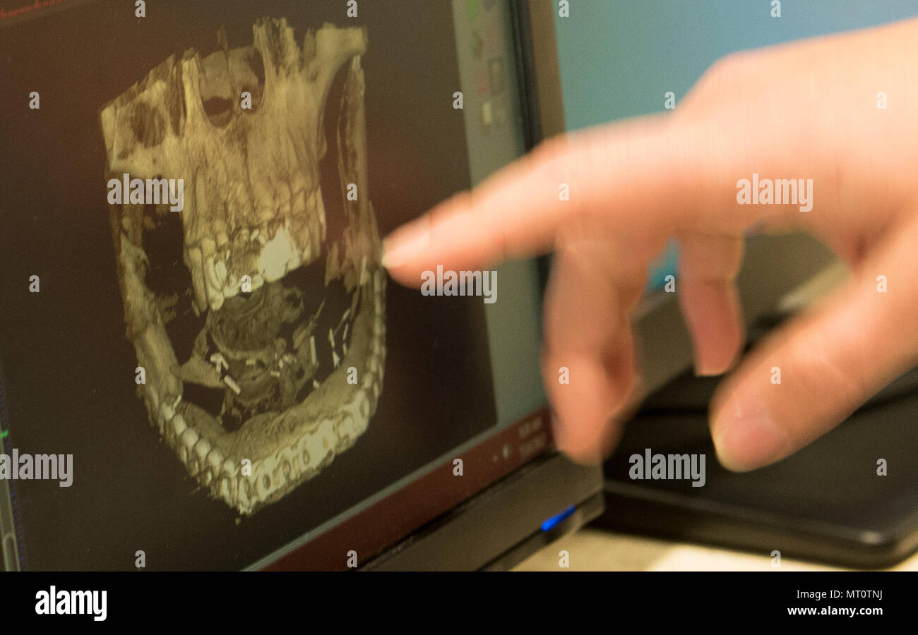 Bilder von einem zahnmedizinischen Kegelstrahl-Computertomographie Maschine werden auf einem Monitor, Juli angezeigt. 14, 2017 David Grant USAF Medical Center, Travis Air Force Base, Calif. Diese X-ray Bilder geben die Ärzte die Möglichkeit zu beobachten, eine komplett dreidimensionale des Schädels und der Zähne des Patienten scannen, genau aufzuzeigen, Problembereiche und zu manipulieren. Care bietet auf der 60 zahnmedizinische Squadron umfasst allgemeine Zahnheilkunde, Parodontologie, Kieferorthopädie, Kinderzahnheilkunde, Endodontie, Prothetik, Mund-, Kiefer- und Gesichtschirurgie. (U.S. Air Force Foto von Heide Couch) Stockfoto