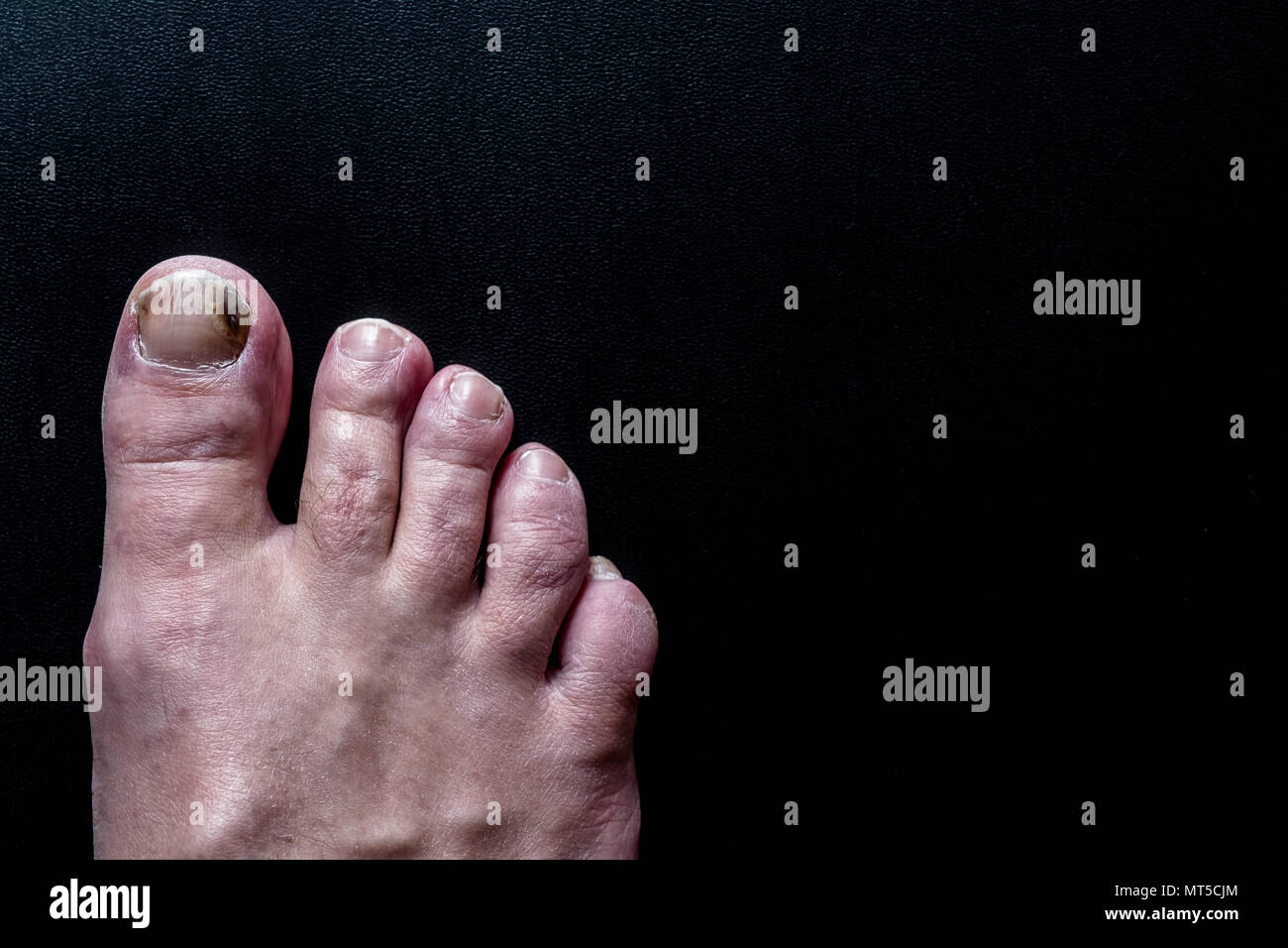 Ein Fuß mit Fußpilz infiziert Zehennagel Stockfoto