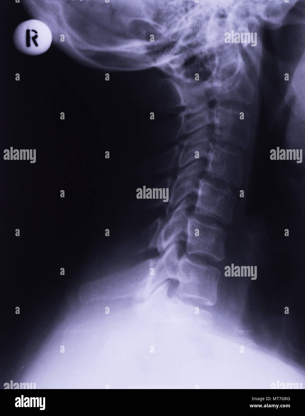X-ray von Hals, seitliche Projektion. Zervikale verstauchung Nachbesserung der lumbalen Lordose Stockfoto