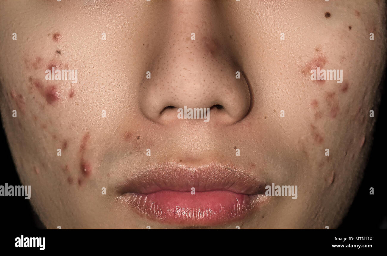 Entzündung Unter Der Haut Im Gesicht www.alamy.de