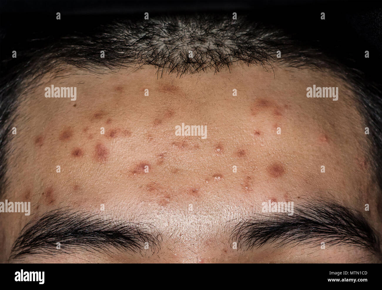 Scars Face Stockfotos Und Bilder Kaufen Alamy