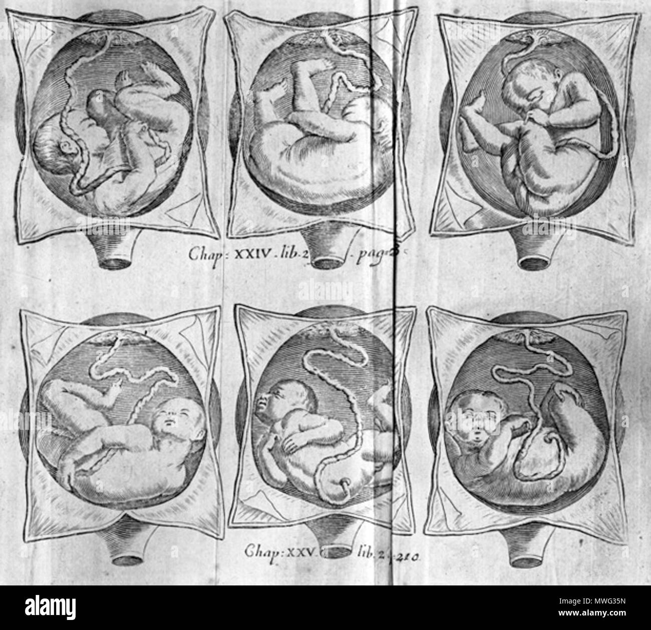 . Francois Mauriceau (1637-1709): Die Krankheiten der Frauen mit Kind, Kind, 1716. Januar 2008. McLeod 407 Mauriceau foetae Stockfoto . Francois Mauriceau (1637-1709): Die Krankheiten der Frauen mit Kind, Kind, 1716. Januar 2008. McLeod 407 Mauriceau foetae Stockfoto