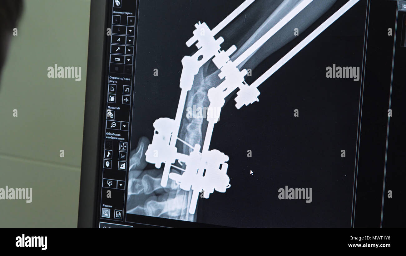 Tierärztin sieht sich der Monitor X-ray Image der Tatze des gebrochenen Hund mit ilizarov der Apparate. X-ray Image der Hund auf dem Monitor in einer Tierklinik. Stockfoto