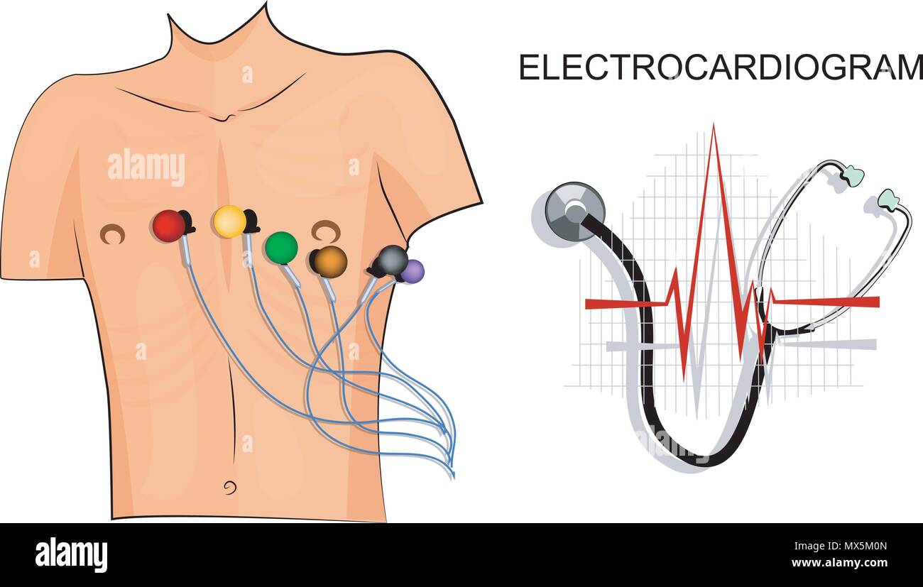 Abbildung: Das Elektrokardiogramm. Der Patient mit Elektroden auf der Brust. Stock Vektor