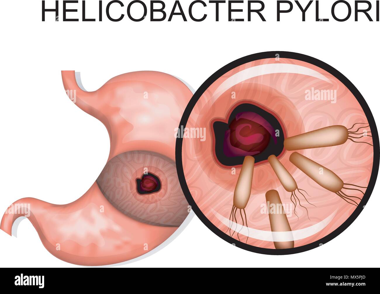 Pathologie des Magens. Anatomie des Magens. Helicobacter pylori Stock Vektor