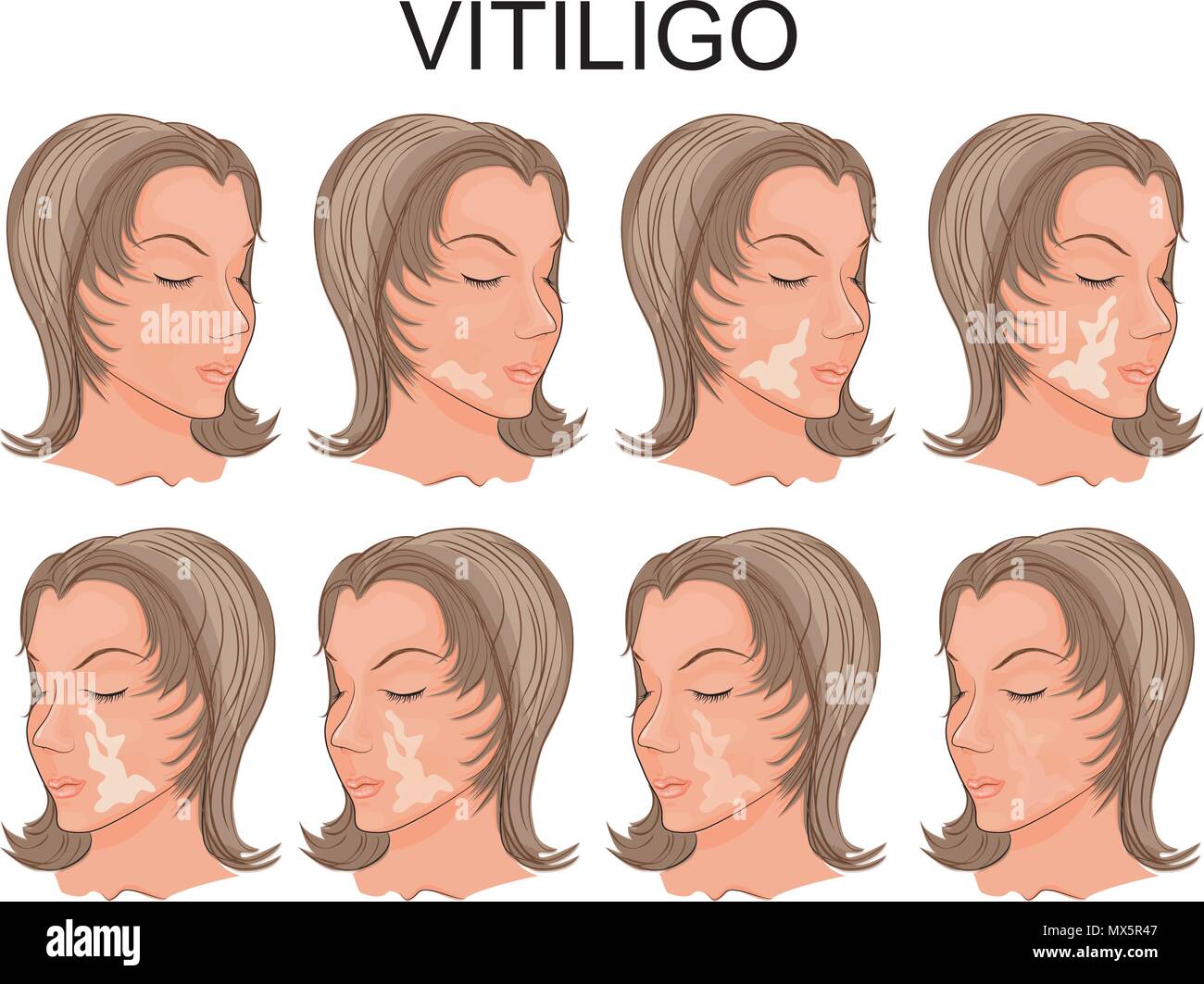 Abbildung: Ein weibliches Gesicht mit Flecken von Vitiligo Stock Vektor