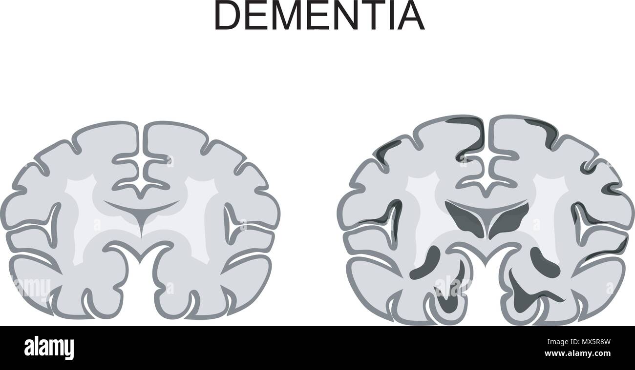 Alzheimer, senile Veränderungen des Gehirns Stock Vektor