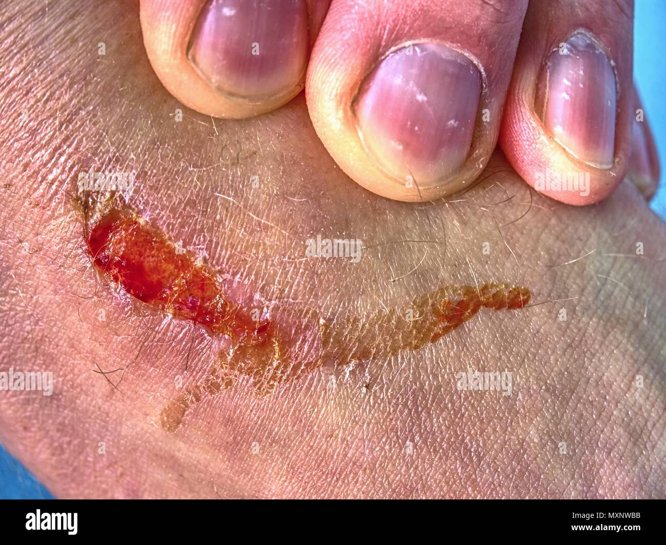 Ärzte hand Heilung ein verbrannter Haut. Hand, die verletzte Stelle mit schmerzhaften Verschleiß, Kratzer von Unfall. Stockfoto