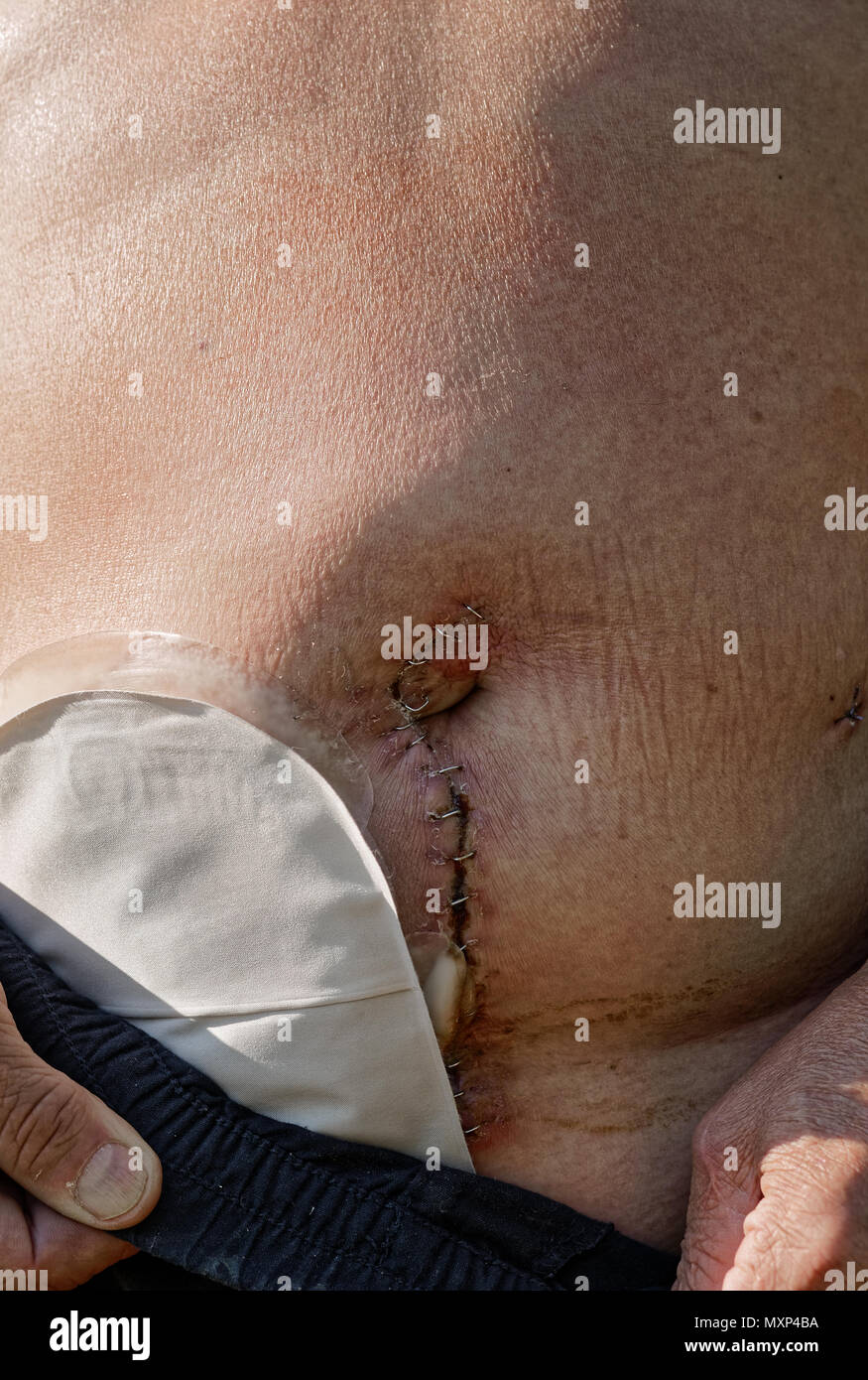 Nach kaukasischer Mann mit temporären stoma nach darmchirurgie Stockfoto