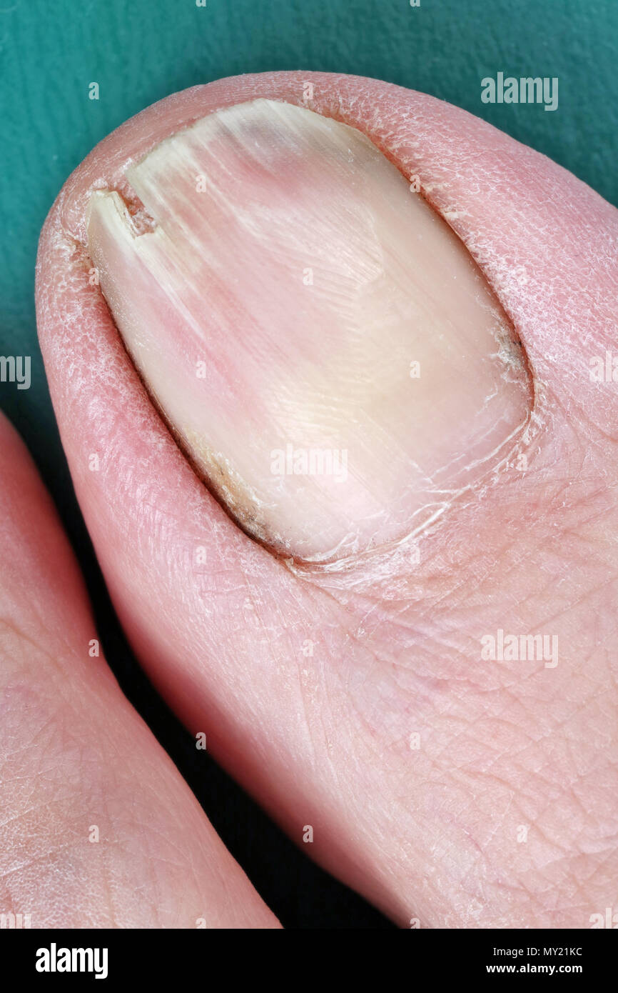 Eines kranken geknackt schmutzigen alten Mann Big Toe Nail Nahaufnahme. Studio Makroaufnahme Stockfoto