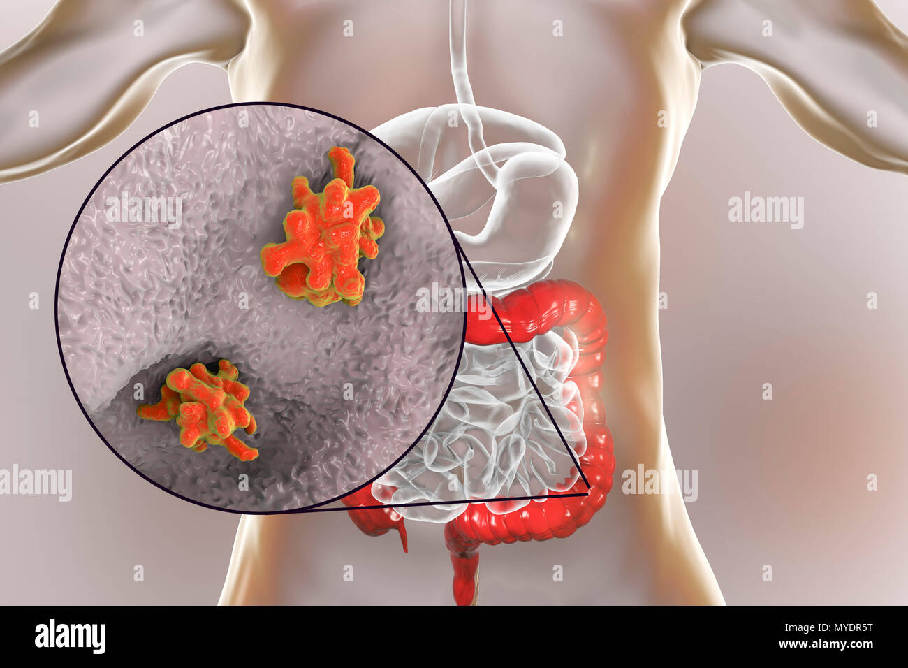 Parasitäre Amöbe (Entamoeba histolytica) im Dickdarm, computer Abbildung. Diese einzelligen Organismus verursacht amöbische Dysenterie und Geschwüre (vegetative trophozoite Stufe). Es wird durch fäkale Verunreinigung von Nahrung und Wasser ausbreiten und ist am häufigsten, wo Hygiene schlecht ist. Amoeben dringen in den Darm, sondern kann auf die Leber, Lunge und andere Gewebe ausbreiten. Infektion wird durch die Einnahme von Zysten, die in die pathogenen Amöben trophozoite hier gesehen. Entamoeba histolytica tritt weltweit mit bis zu 50% der Bevölkerung infiziert werden vor allem in wärmeren Klimazonen. Stockfoto