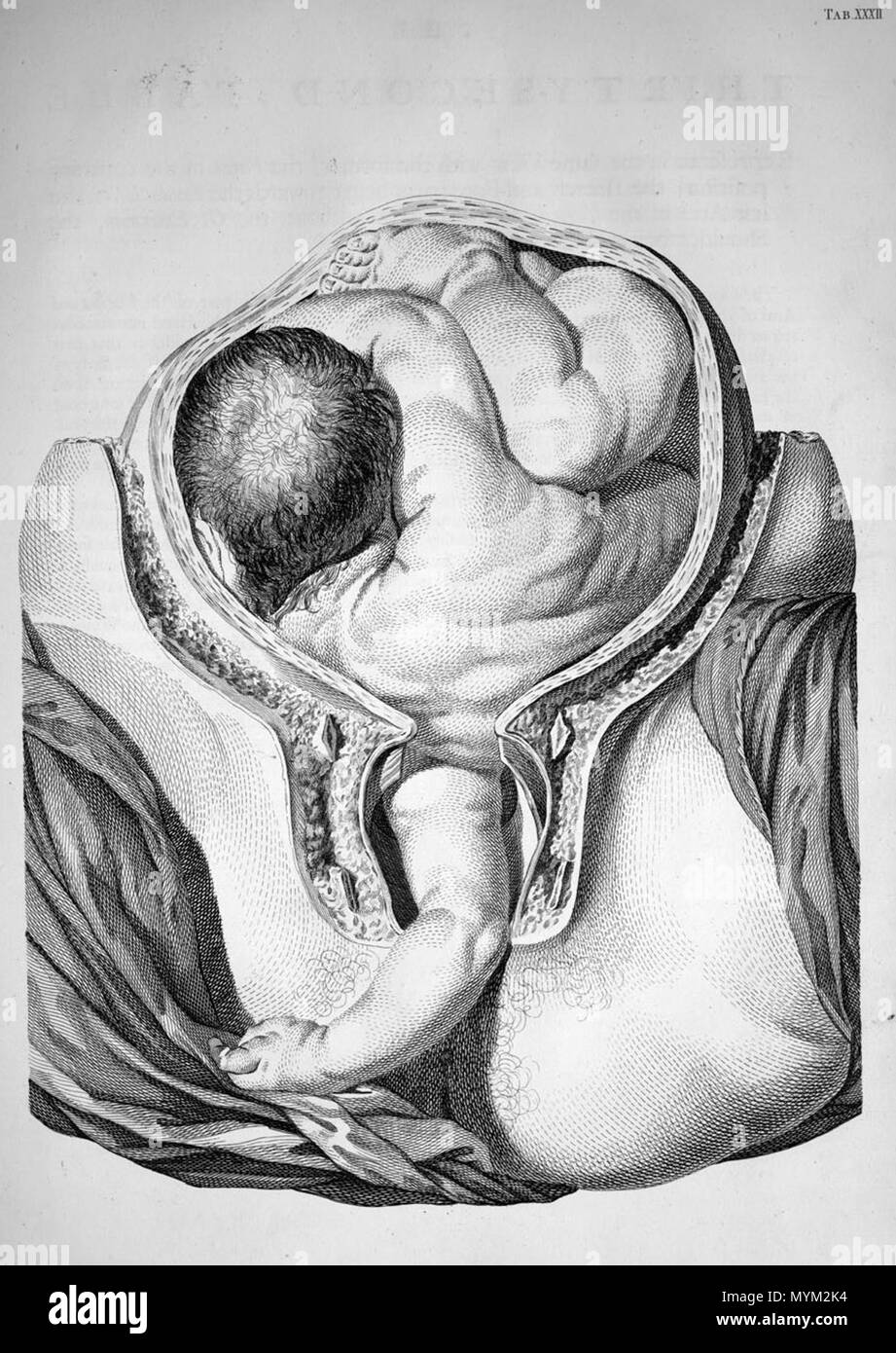 . William Smellie (1697-1763): EIN Sett von anatomischen Tabellen mit Erläuterungen und eine Kürzung der Praxis der Geburtshilfe, 1754. Januar 2008. McLeod 493 Smellie Komplikation Stockfoto
