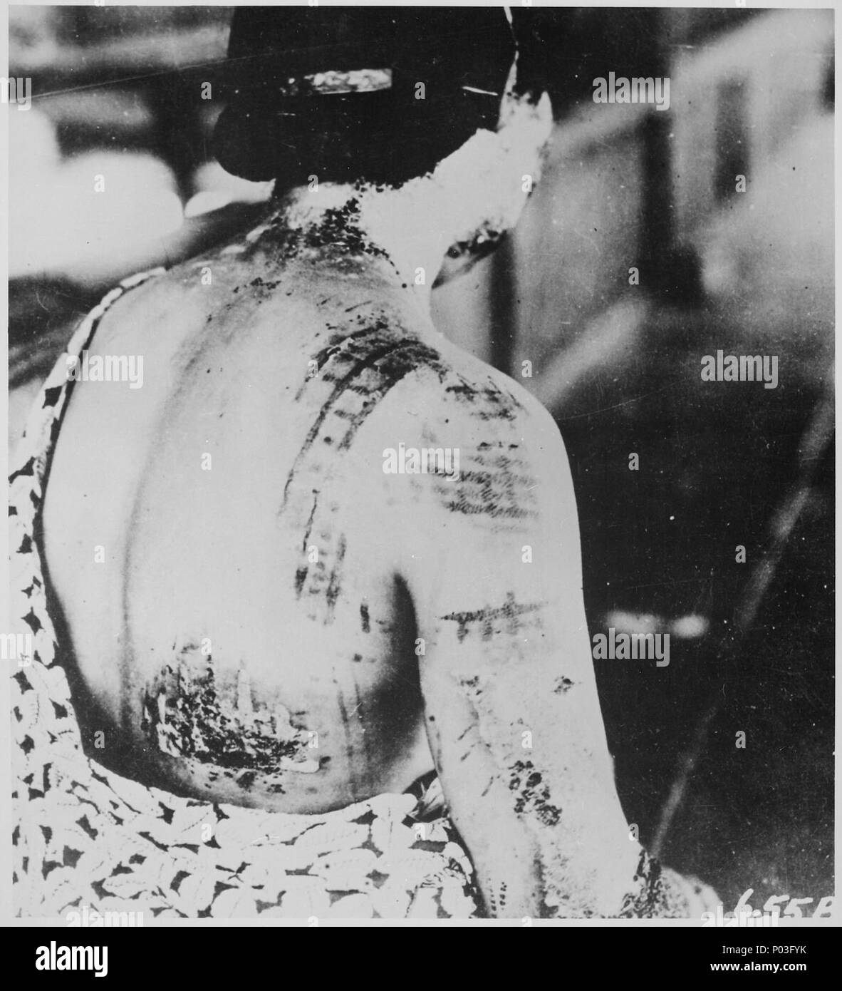 Die Haut des Patienten ist in einem Muster entspricht, die dunklen Bereiche eines Kimono getragen zum Zeitpunkt der Explos Brandopfer. Stockfoto