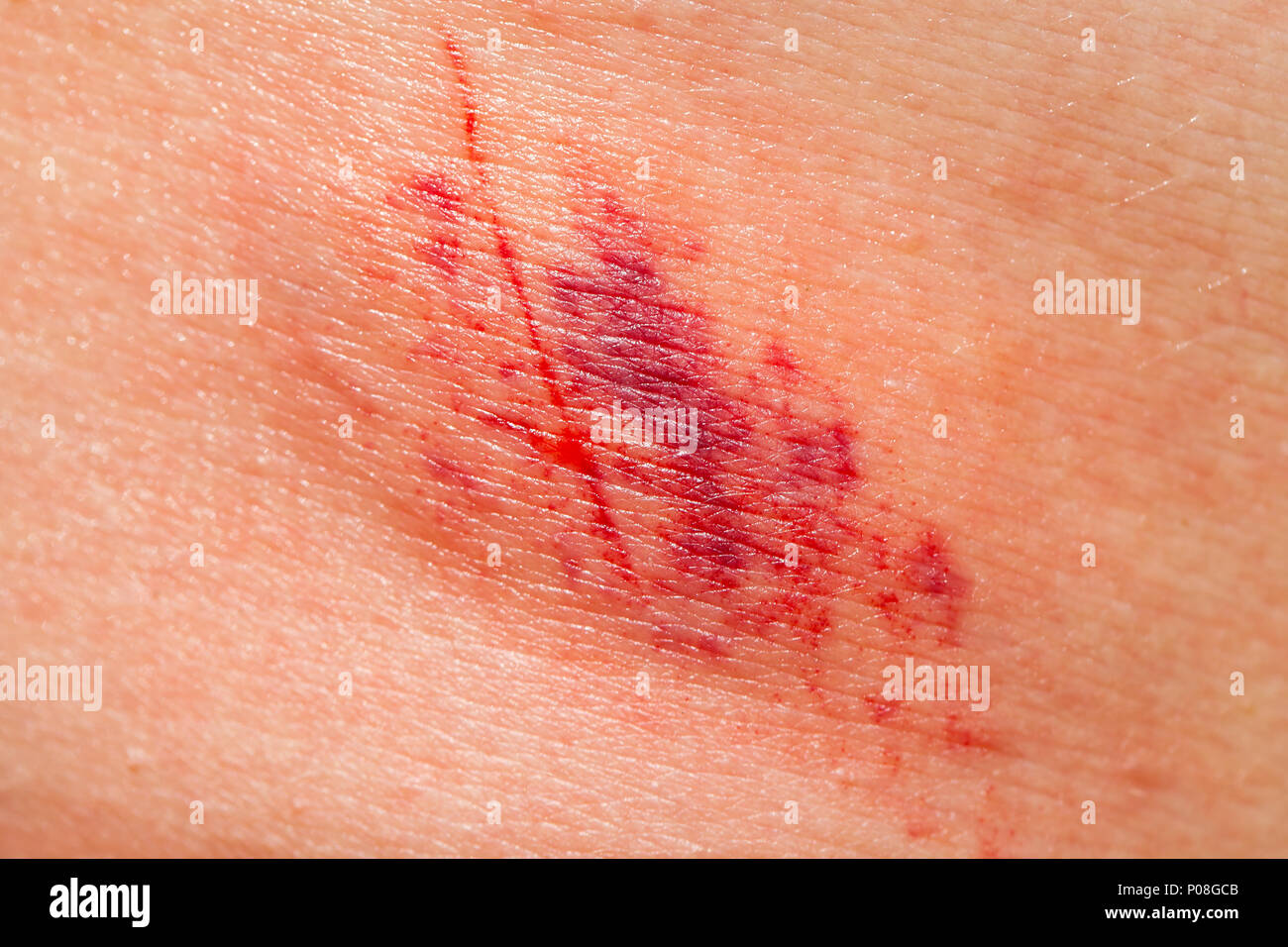 Hämatom am knie Fotos und Bildmaterial in hoher Auflösung Alamy