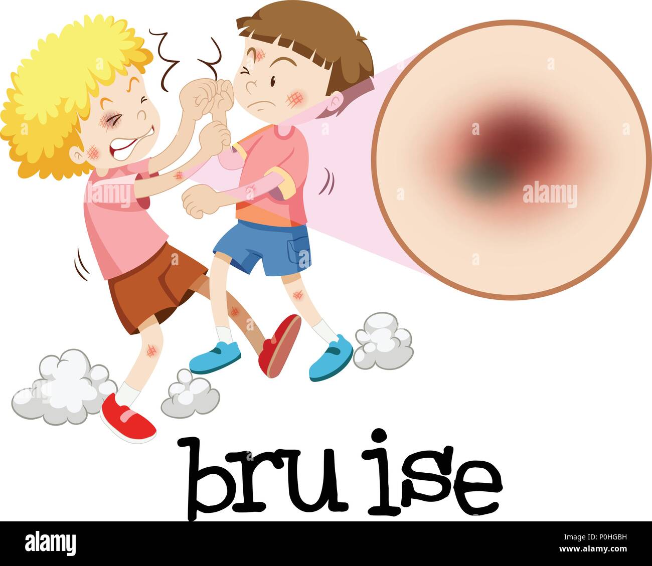 Jungen kämpfen mit vergrößerten bruise Abbildung Stock Vektor