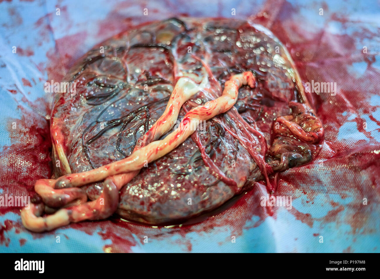 Plazenta außerhalb der Gebärmutter unmittelbar nach der Geburt im Krankenhaus Stockfoto