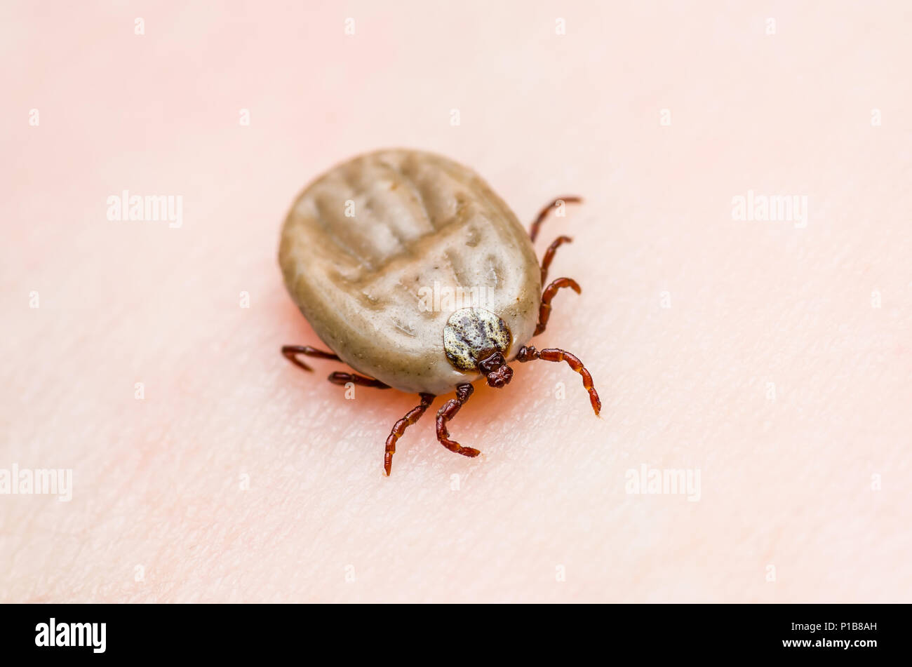 Enzephalitis Virus oder Lyme Krankheit oder Affe Fieber infizierte Zecke Spinne Insekt auf der Haut Stockfoto