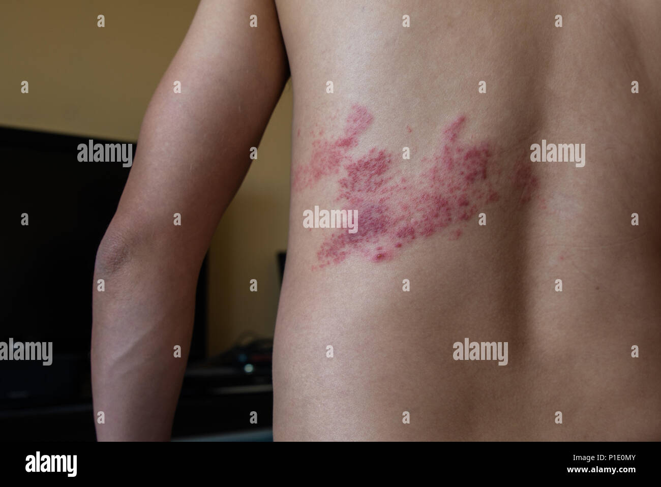 Herpes Zoster Stockfotos &amp; Herpes Zoster Bilder Alamy