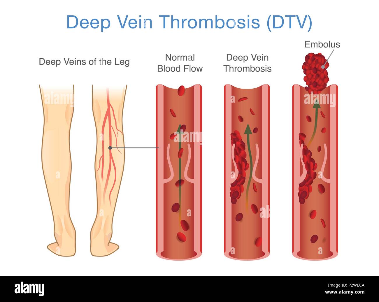 Medizinische Darstellung von tiefen Venenthrombosen im Beinbereich. Stock Vektor