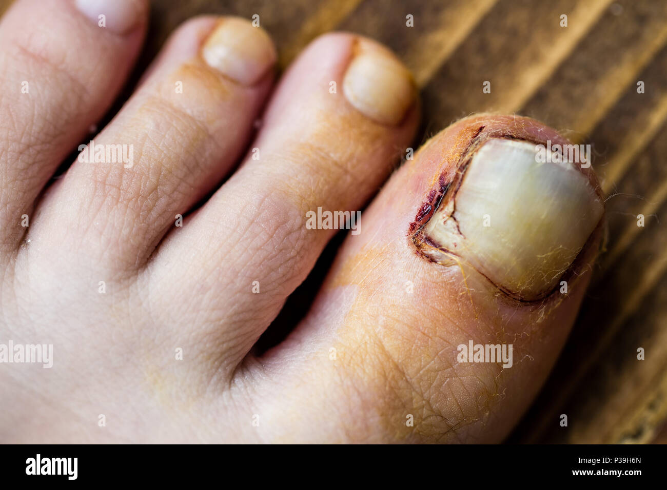 Neu gebrochene Nagel über vom Finger von traumatischen Unfall zu heben Stockfoto