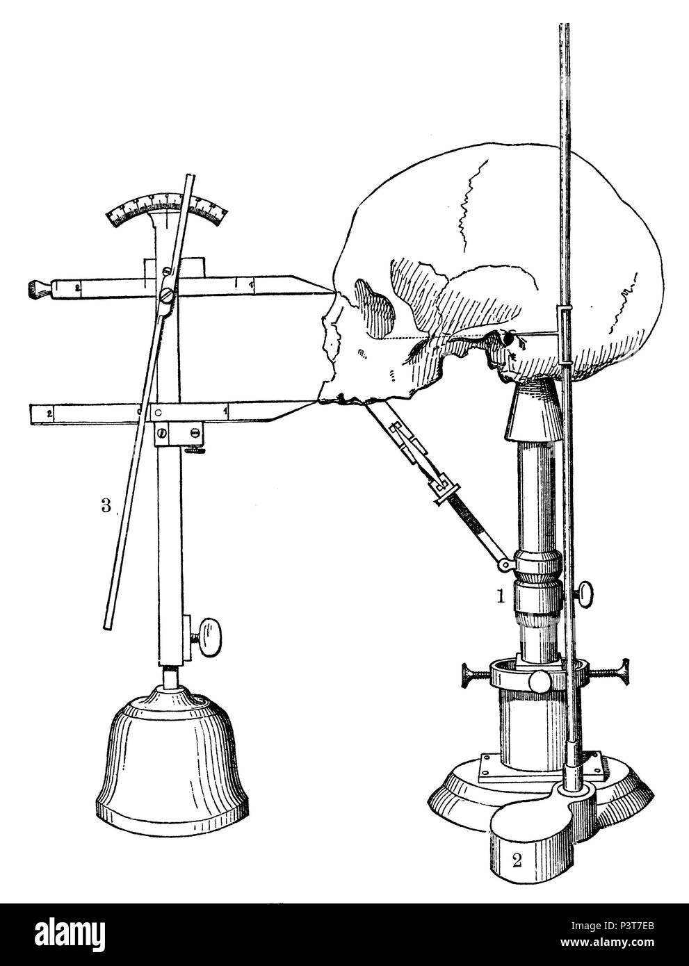 Winkelmessung auf dem Schädel eines Menschen: 1 Sprengels Kraniophor, 2 Höhenmesser, 3 Goniiometer, 1894 Stockfoto