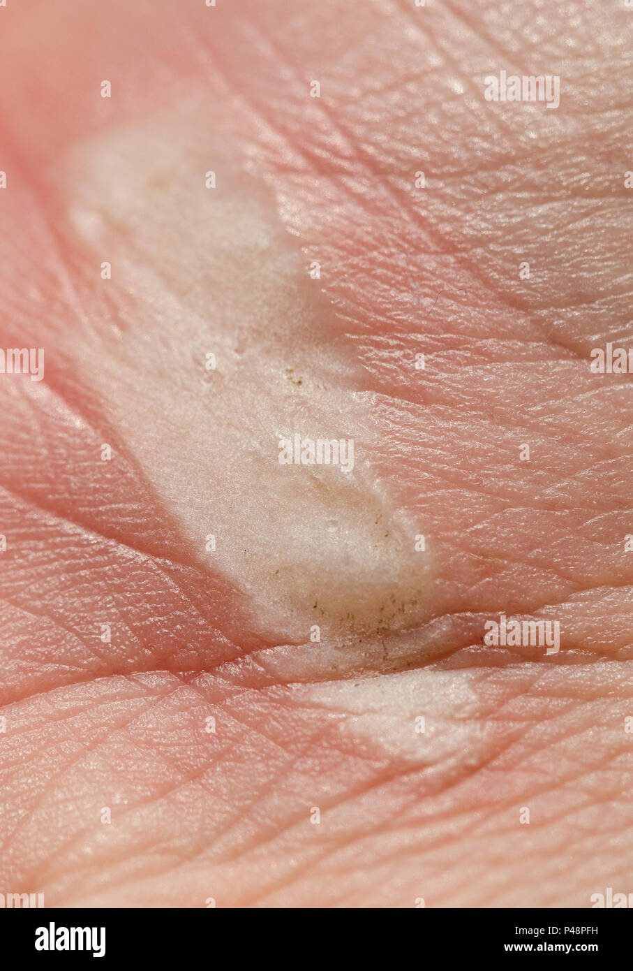 Verbrennung zweiten grades auf der hand Fotos und Bildmaterial in