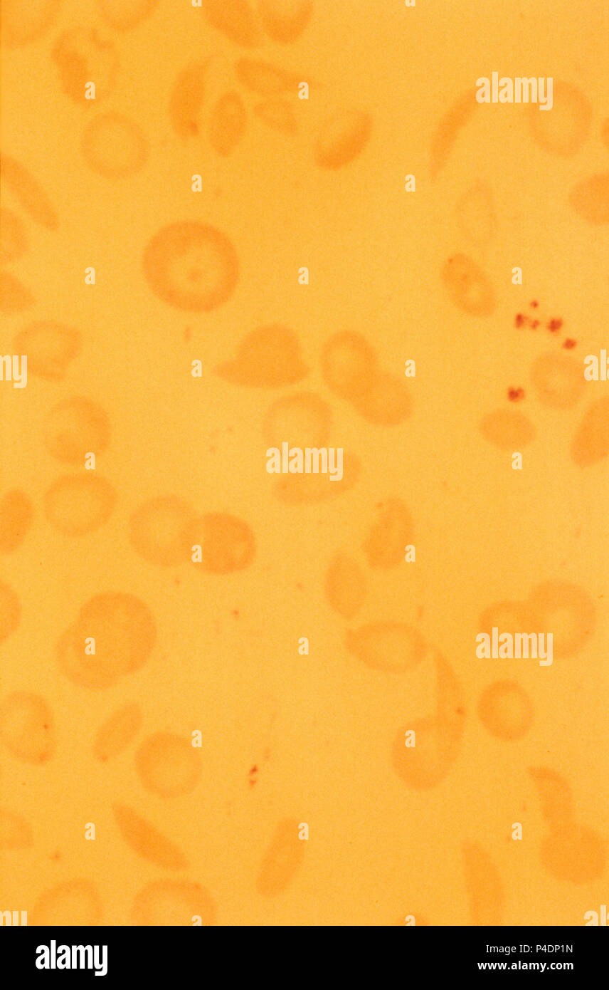 Sichelzellen Erythrozyten Stockfoto
