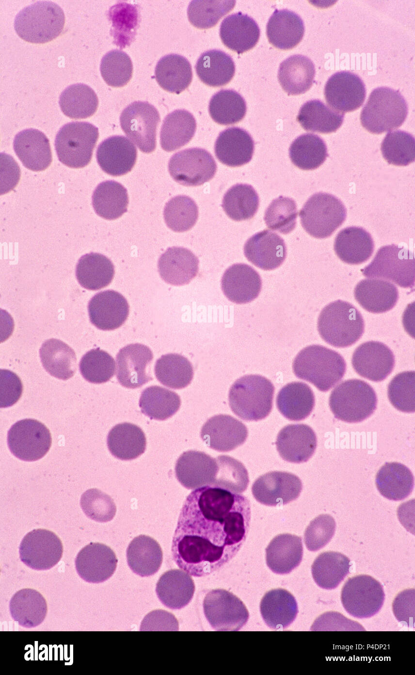Rote Blutkörperchen mit spherocytosis Stockfoto