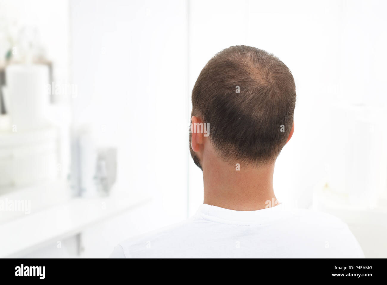 Alopezie. Der Kopf eines Mannes mit dünner werdendem Haar Stockfoto