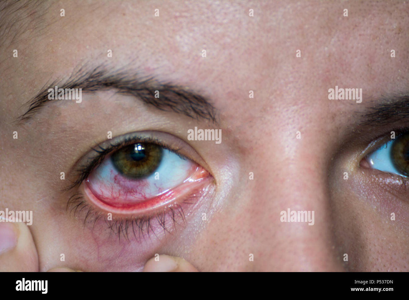 Eine infizierte Auge mit bindehautentzündung oder Rosa Auge Stockfoto