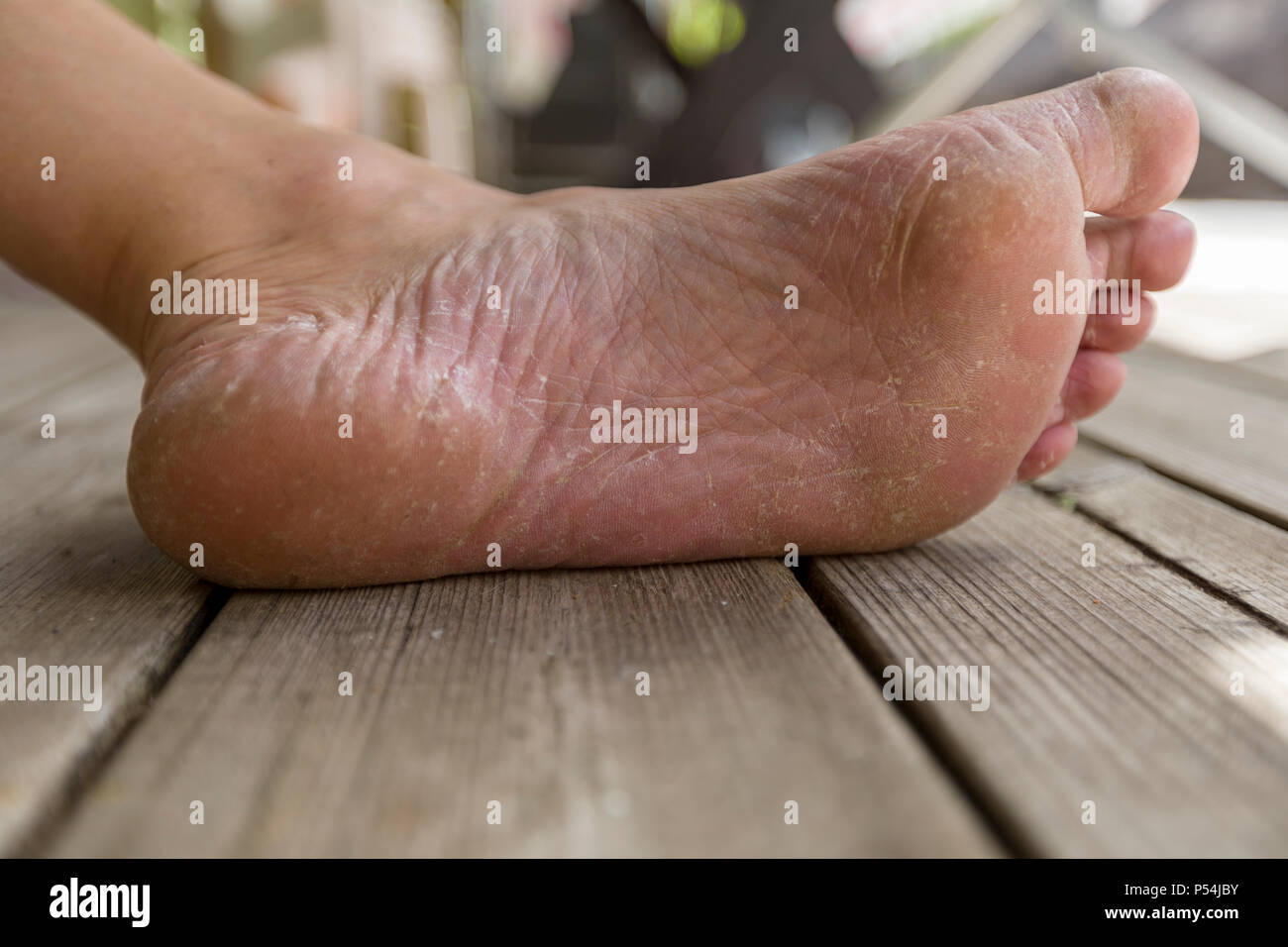 Nahaufnahme der schlechten des erwachsenen Mannes Fußpilz und trockene rissige Fersen Stockfoto