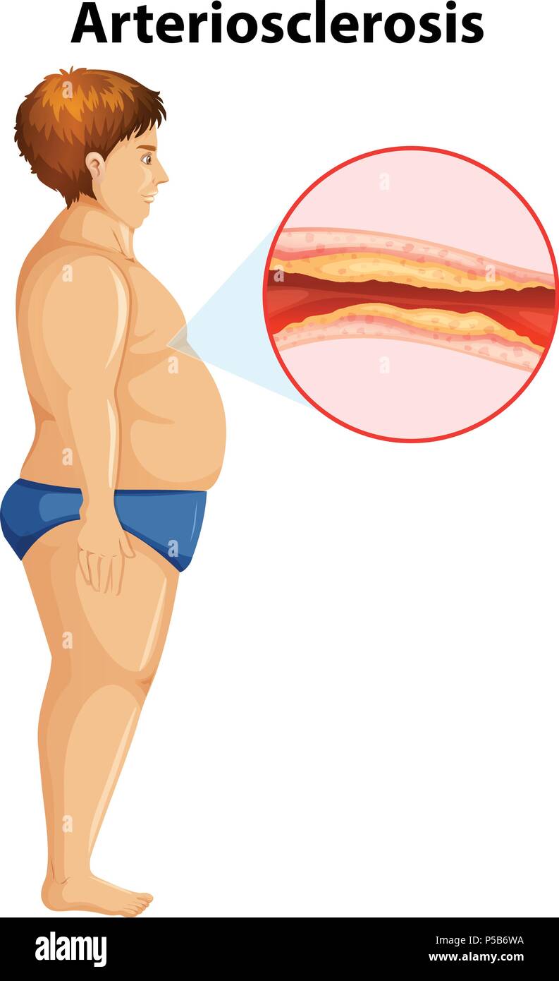 Ein übergewichtiger Mann mit Arteriosklerose Abbildung Stock Vektor