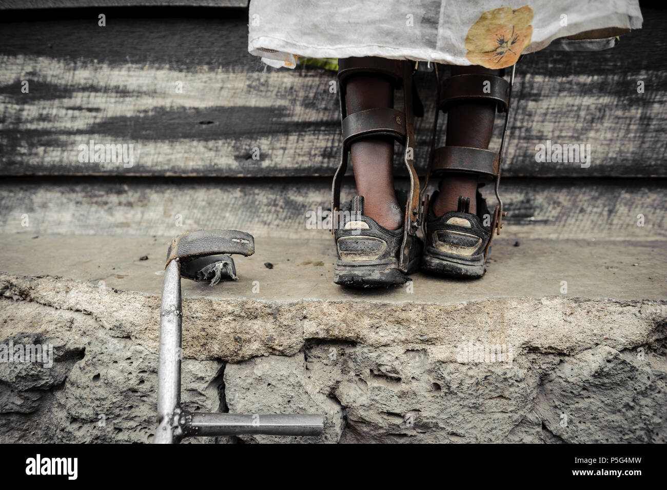 Ein 8-jähriges Mädchen, das von einer NGO in Goma (DRC) mit Bremssätteln ausgestattet wurde und Kindern hilft, die unter den Auswirkungen des Polio-Virus leiden Stockfoto