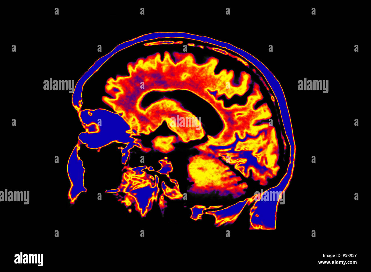 Eingefärbte MRT-Bild von Kopf, Gehirn Stockfoto