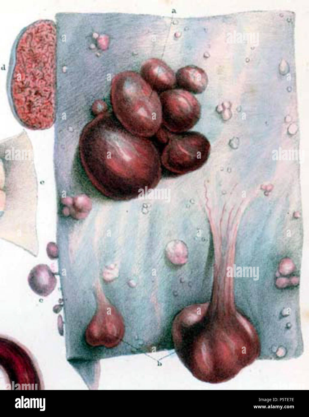 N/A. Englisch: Pathologische Anatomie Illustrationen von den elementaren Formen der Krankheit. 8 Januar 2014, 04:49:32. Robert Carswell 277 Carswell Karzinom 3 df1 Stockfoto