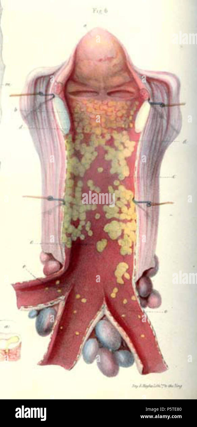 N/A. Englisch: Pathologische Anatomie Illustrationen von den elementaren Formen der Krankheit. 8 Januar 2014, 04:49:37. Robert Carswell 277 Carswell pus 1 df6 Stockfoto