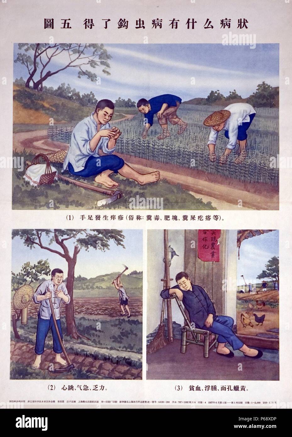 Chinesische Plakat zeigt drei verschiedene Bilder, die entworfen sind, um das Bewusstsein von hookworm Infektion zu erhöhen. Jedes Bild zeigt ein Landwirt, Symptome der Infektion. Chinesische Zeichen sind unter jedem Bild gezeigt, die typischen Anzeichen der Infektion. Vom c 1940 Stockfoto