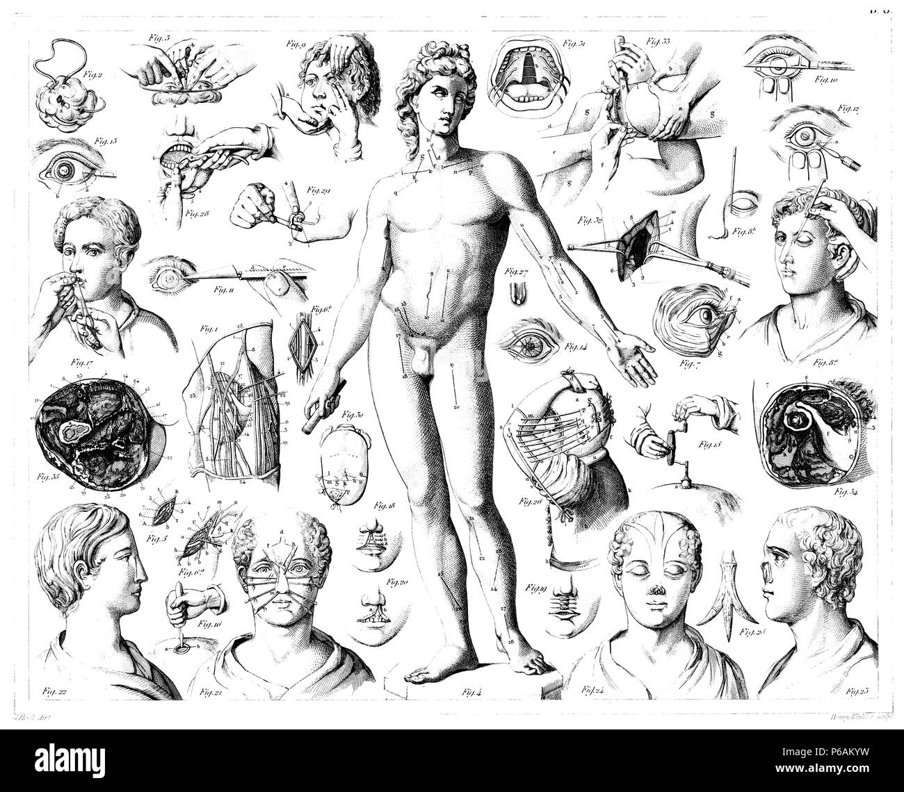 Operationen auf Menschen, Heck u. Henry Winkles Stockfoto