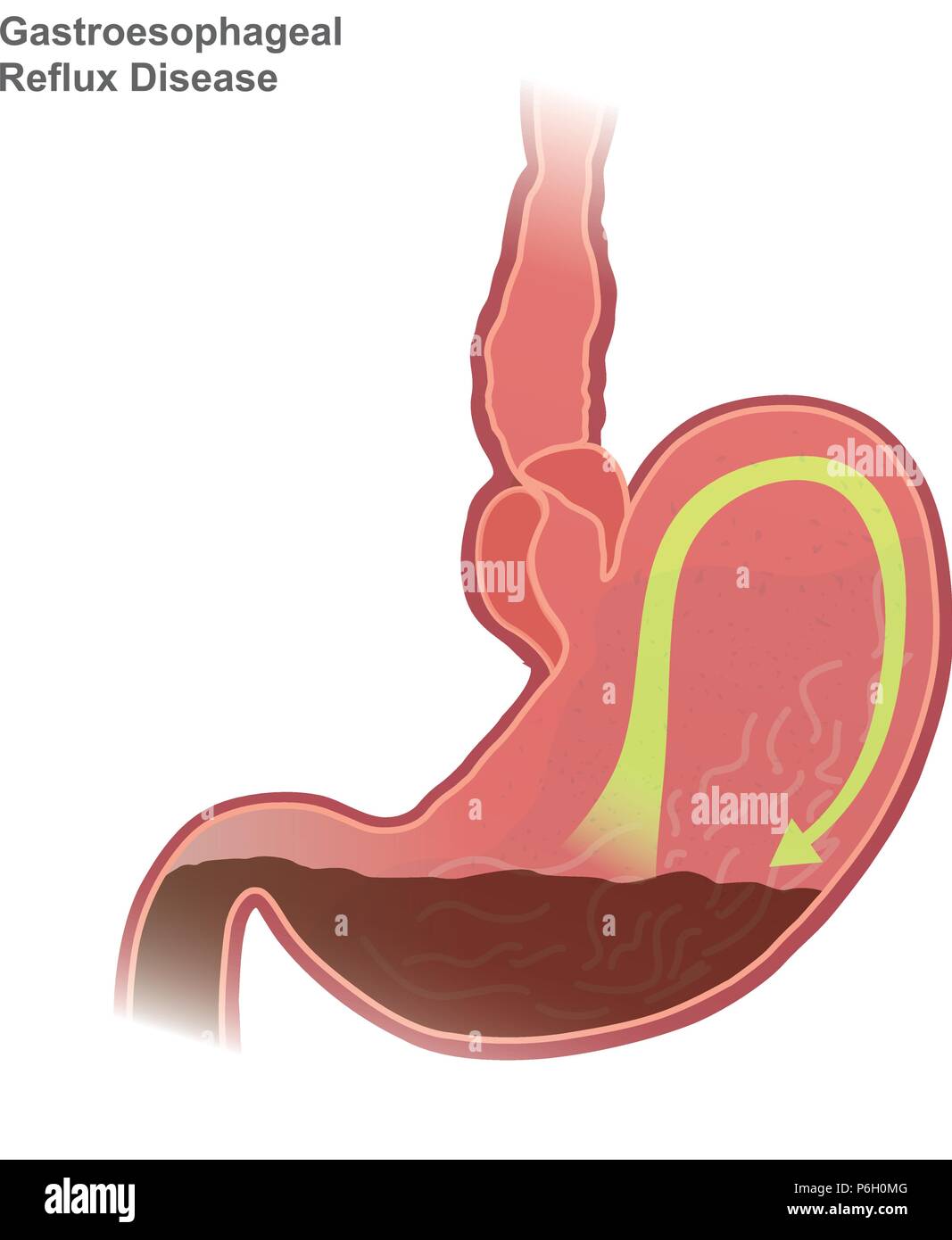 Gastroösophageale Refluxkrankheit GERD, auch als Acid Reflux genannt, ist eine langfristige Zustand, in dem Mageninhalt in die Speiseröhre kommen Resultat Stock Vektor