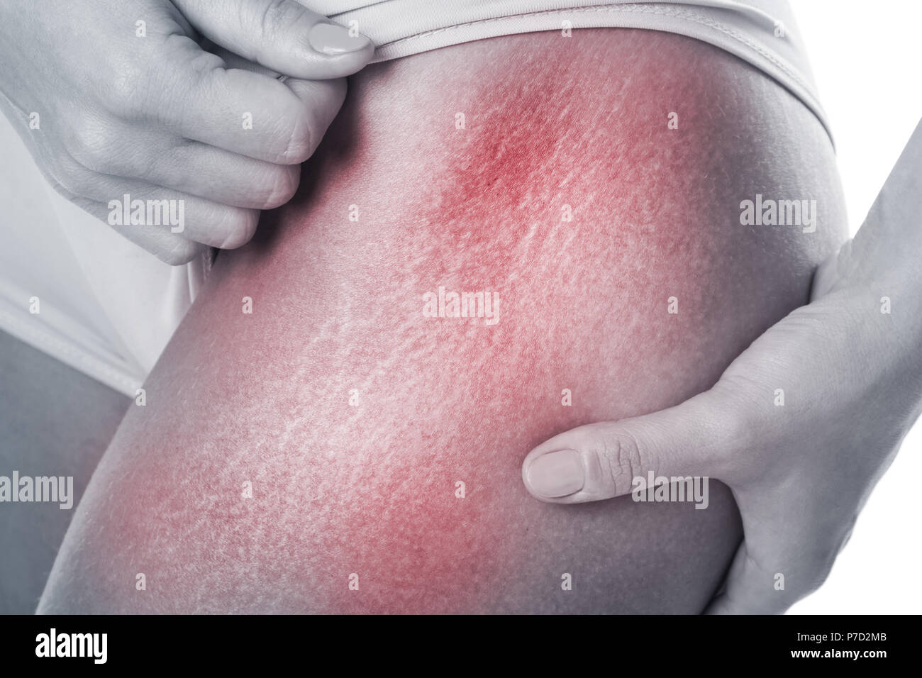 Weibliche Hüften mit einer Strecke Schlieren Markierungen Stockfoto
