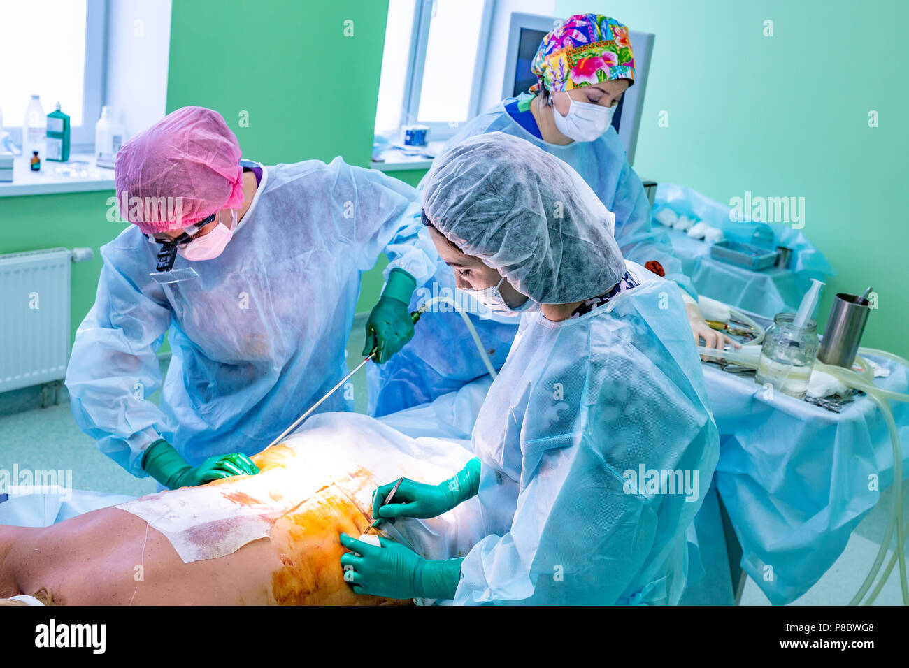 Kosmetische Fettabsaugung Chirurgie im eigentlichen Operationssaal, Gruppe der Operateure mit Kanüle Stockfoto