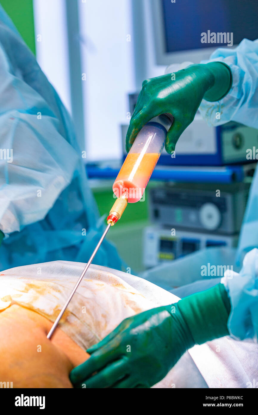 Liposuct Kan 30cm 3mm Griffans | Liposuction-Kanülen | Infiltration