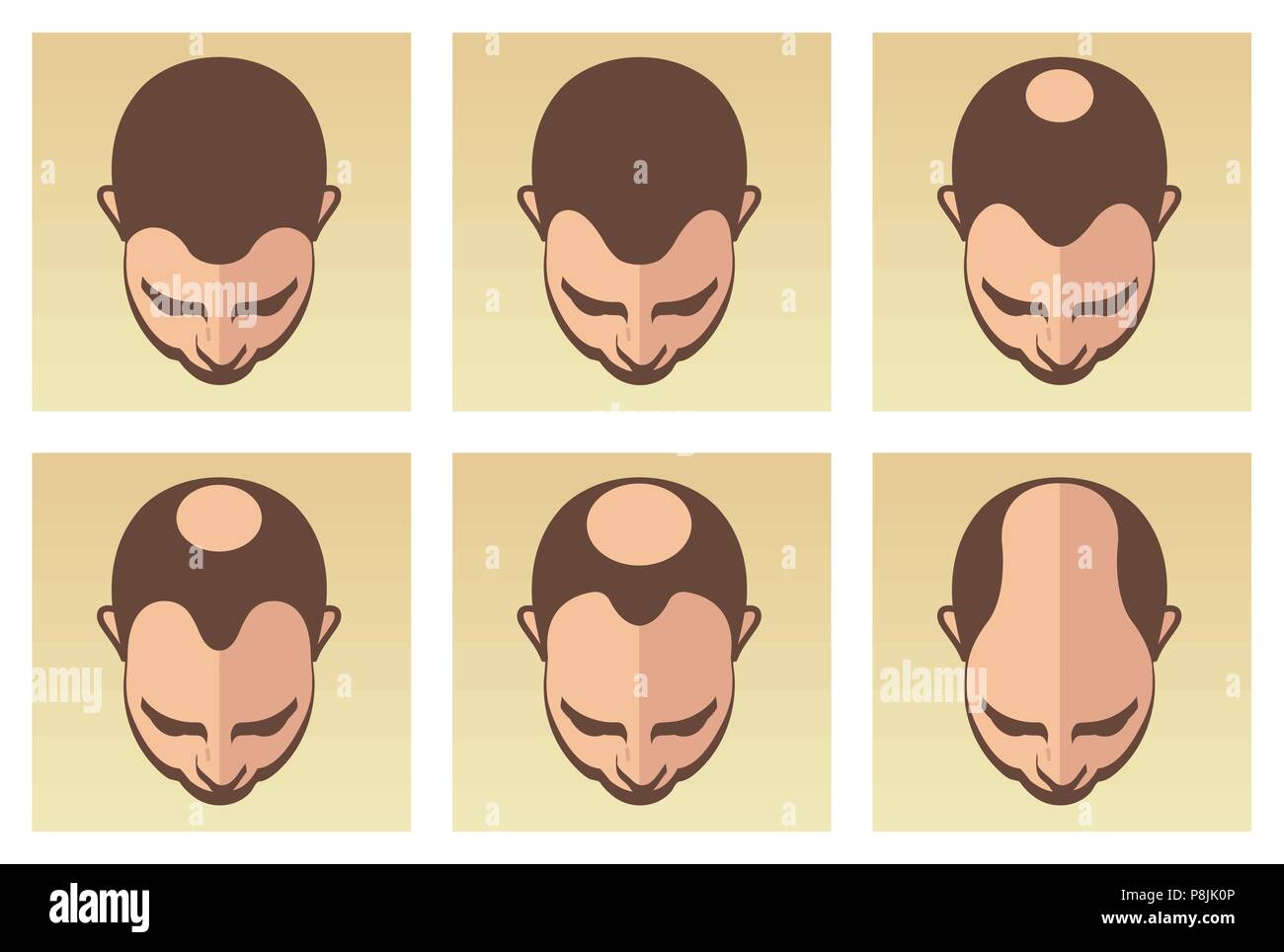Ein Vektor Abbildung mit verschiedenen Phasen der männlichen Haarausfall. Stock Vektor